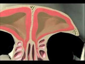 Read more about the article Balloon Sinuplasty
