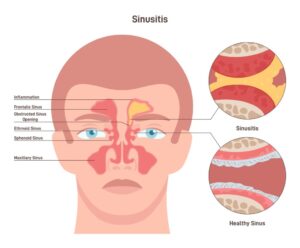 Sinus Infections